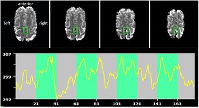Graded fMRI Neurofeedback Training of Motor Imagery in Middle Cerebral Artery Stroke Patients: A Preregistered Proof-of-Concept Study
